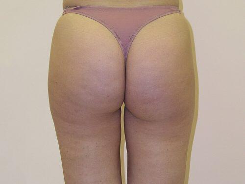 Liposuction  Before & After Image