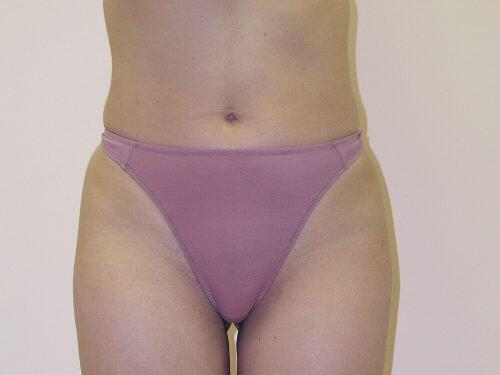 Liposuction  Before & After Image