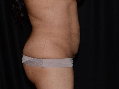 Liposuction  Before & After Image