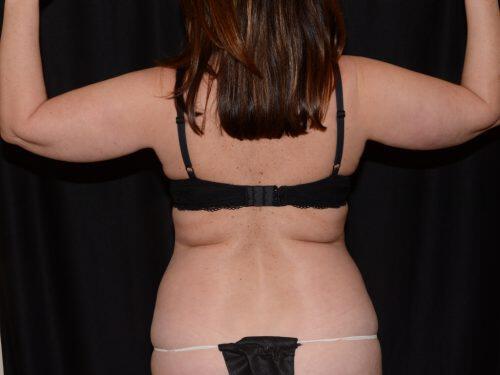 Liposuction  Before & After Image