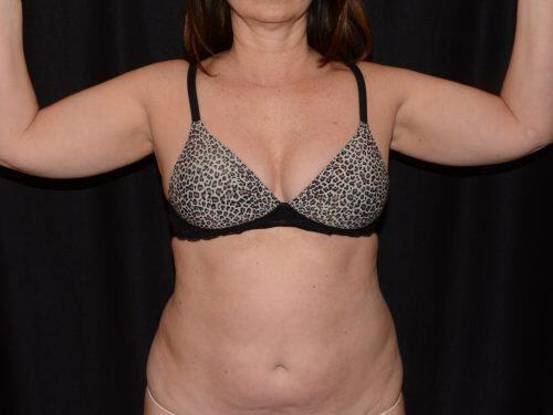 Liposuction  Before & After Image