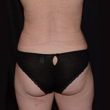 Liposuction  Before & After Image