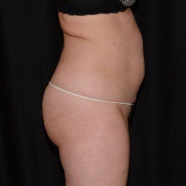 Liposuction  Before & After Image