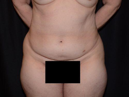 Tummy Tuck  Before & After Image