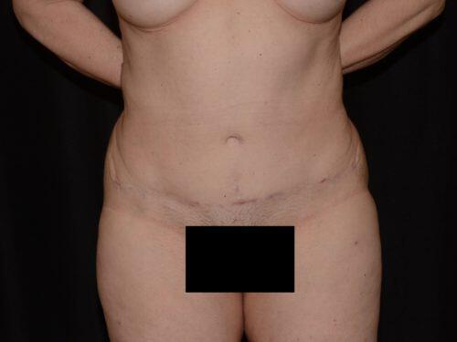 Tummy Tuck  Before & After Image