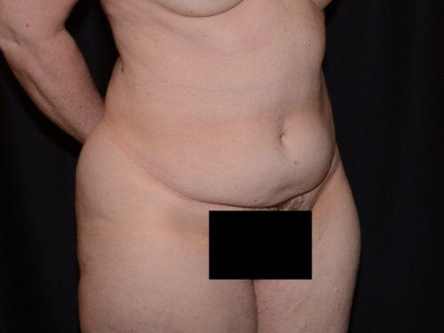 Tummy Tuck  Before & After Image