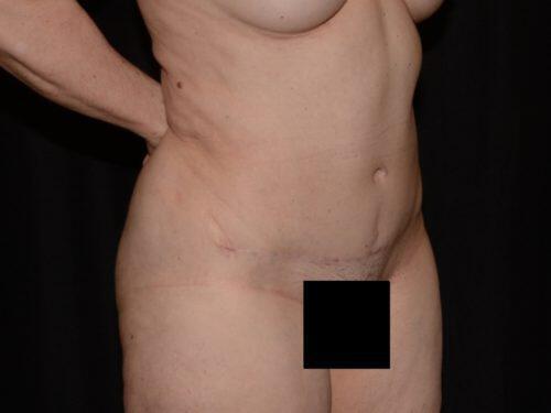 Tummy Tuck  Before & After Image