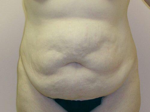 Tummy Tuck  Before & After Image