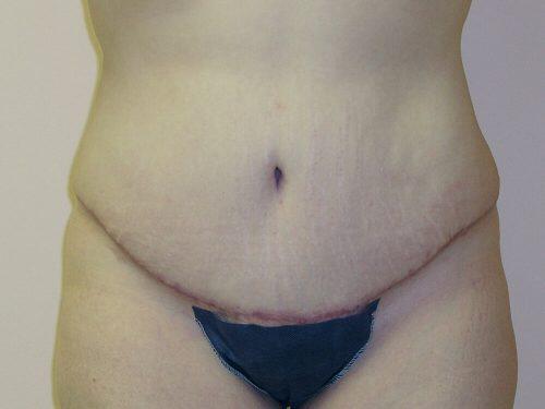 Tummy Tuck  Before & After Image