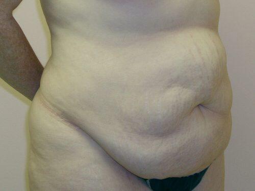 Tummy Tuck  Before & After Image