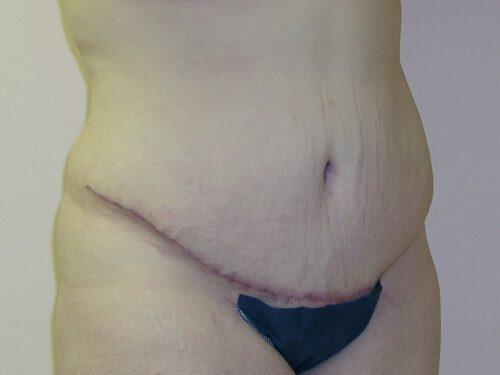 Tummy Tuck  Before & After Image