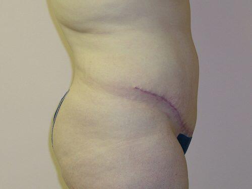 Tummy Tuck  Before & After Image