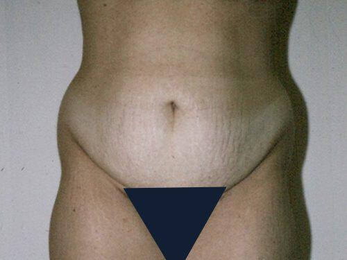 Tummy Tuck  Before & After Image