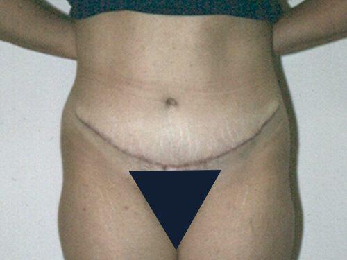 Tummy Tuck  Before & After Image