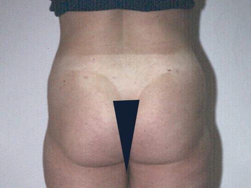 Tummy Tuck  Before & After Image