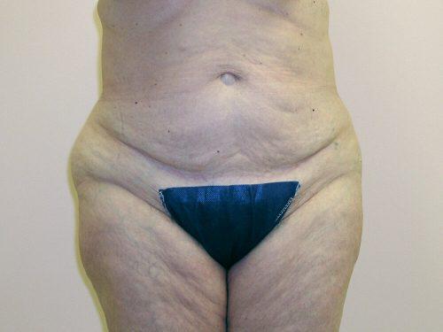 Tummy Tuck  Before & After Image