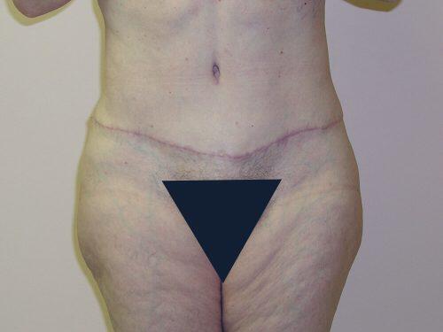 Tummy Tuck  Before & After Image