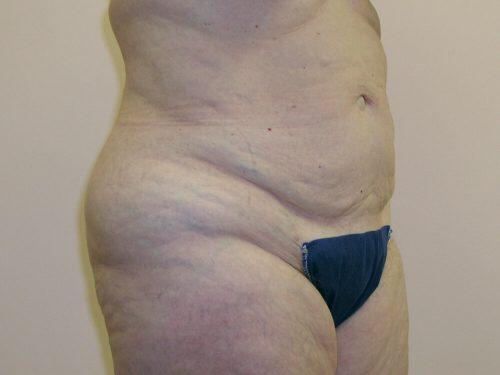 Tummy Tuck  Before & After Image