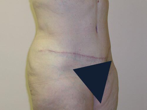 Tummy Tuck  Before & After Image