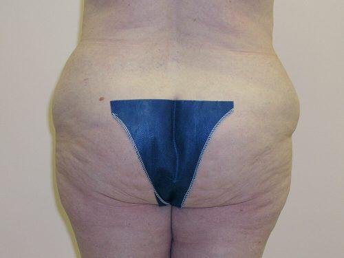 Tummy Tuck  Before & After Image