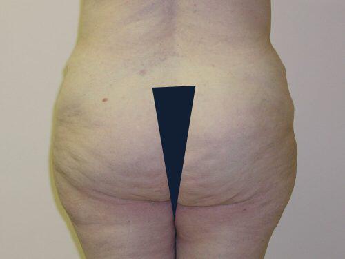 Tummy Tuck  Before & After Image