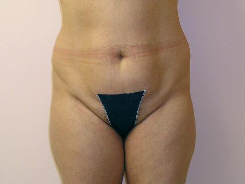 Tummy Tuck  Before & After Image