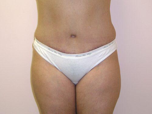 Tummy Tuck  Before & After Image