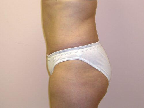 Tummy Tuck  Before & After Image