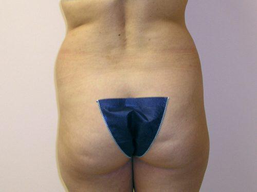 Tummy Tuck  Before & After Image