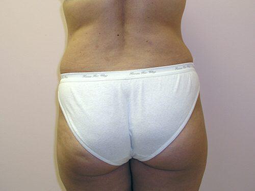 Tummy Tuck  Before & After Image