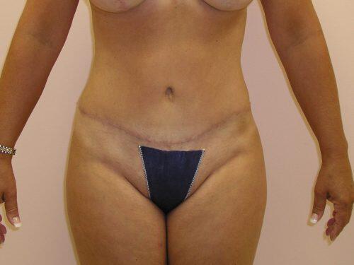 Tummy Tuck  Before & After Image