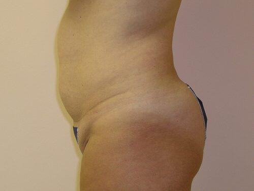 Tummy Tuck  Before & After Image