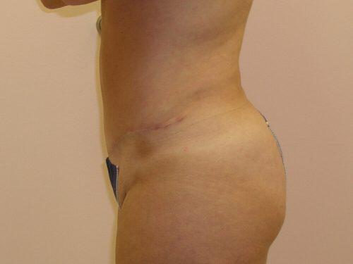 Tummy Tuck  Before & After Image