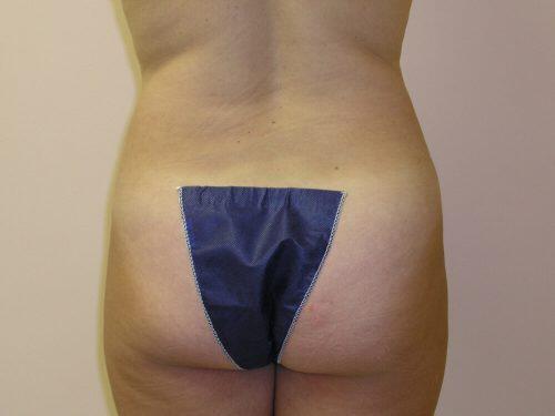 Tummy Tuck  Before & After Image