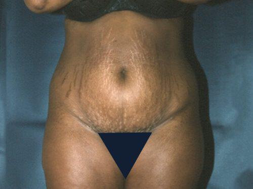 Tummy Tuck  Before & After Image