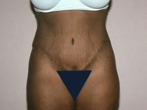 Tummy Tuck  Before & After Image