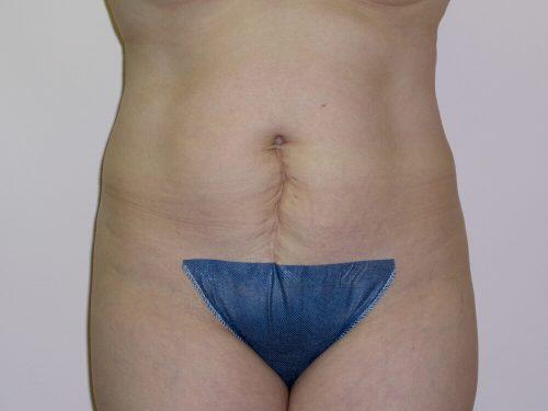 Tummy Tuck  Before & After Image