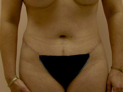 Tummy Tuck  Before & After Image