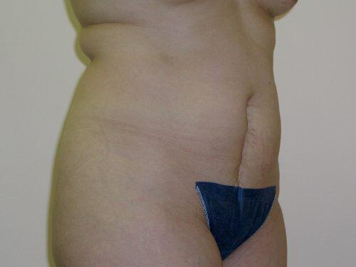 Tummy Tuck  Before & After Image