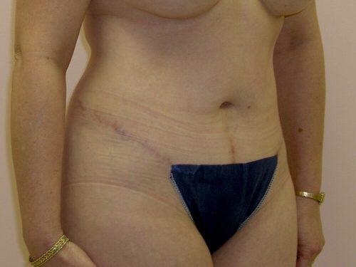 Tummy Tuck  Before & After Image