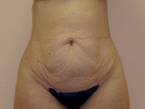 Tummy Tuck  Before & After Image