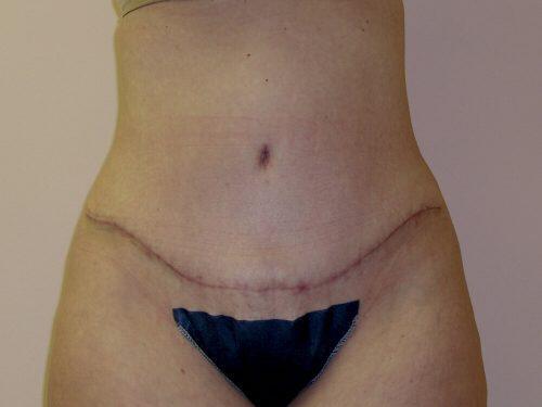 Tummy Tuck  Before & After Image