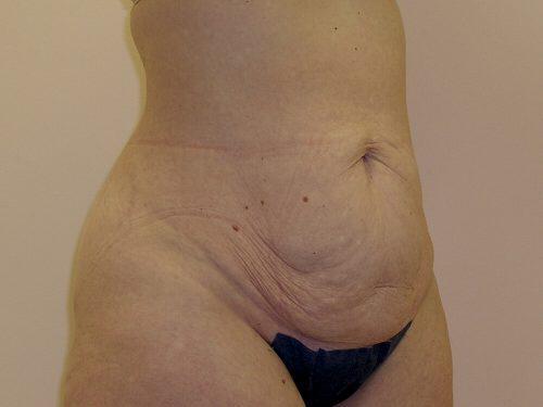 Tummy Tuck  Before & After Image