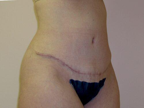 Tummy Tuck  Before & After Image