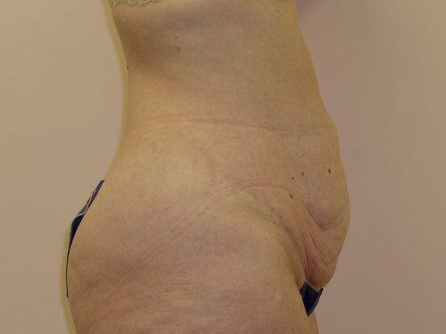 Tummy Tuck  Before & After Image