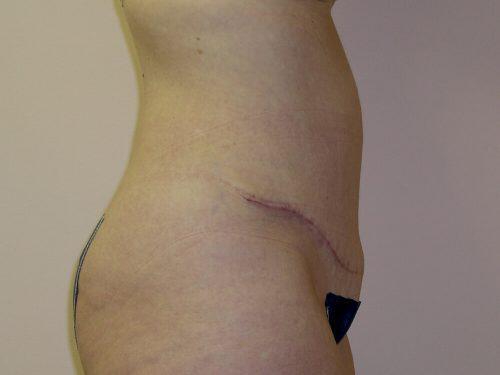 Tummy Tuck  Before & After Image