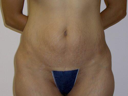 Tummy Tuck  Before & After Image