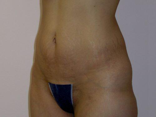 Tummy Tuck  Before & After Image