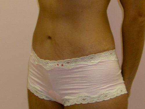 Tummy Tuck  Before & After Image