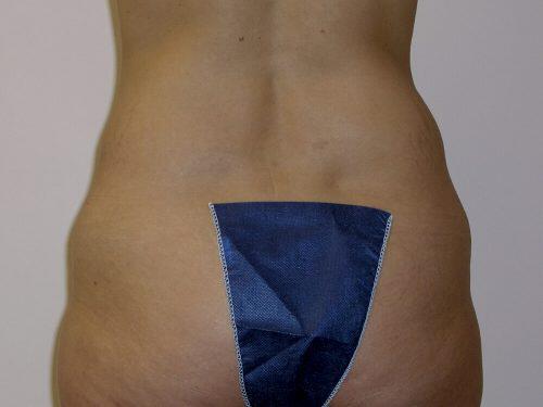 Tummy Tuck  Before & After Image